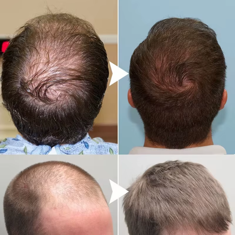 Sérum de croissance des cheveux au gingembre, huile essentielle de repousse rapide de 7 jours, Anti-chute des cheveux, prévient les cheveux secs, crépus et endommagés, produits de réparation